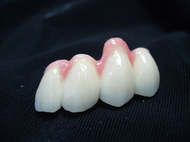 Anterior bridge with hand-crafted pink gingival characterization mimicking natural gum tissue