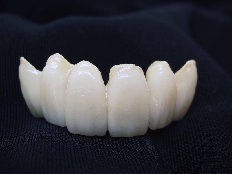 Lower anterior porcelain veneers, incisal view showing natural enamel translucency and warm dentin tones