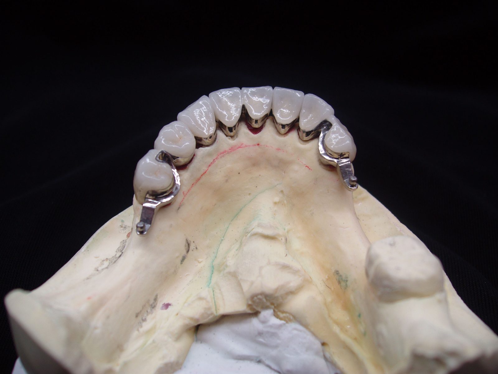 Full-arch fixed restoration on stone model