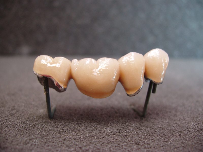 Four-unit porcelain-fused-to-metal (PFM) bridge shown on pontic pins, ready for delivery