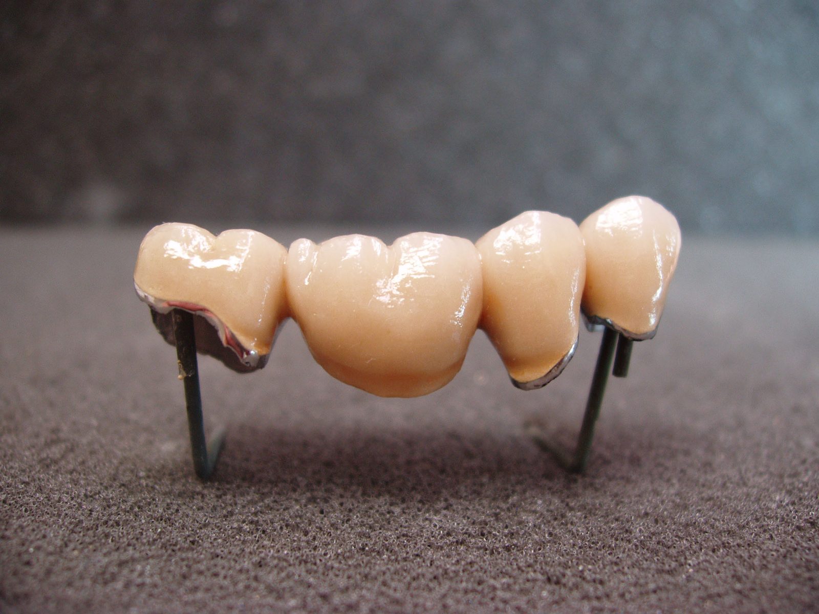 4-unit porcelain-fused-to-metal bridge