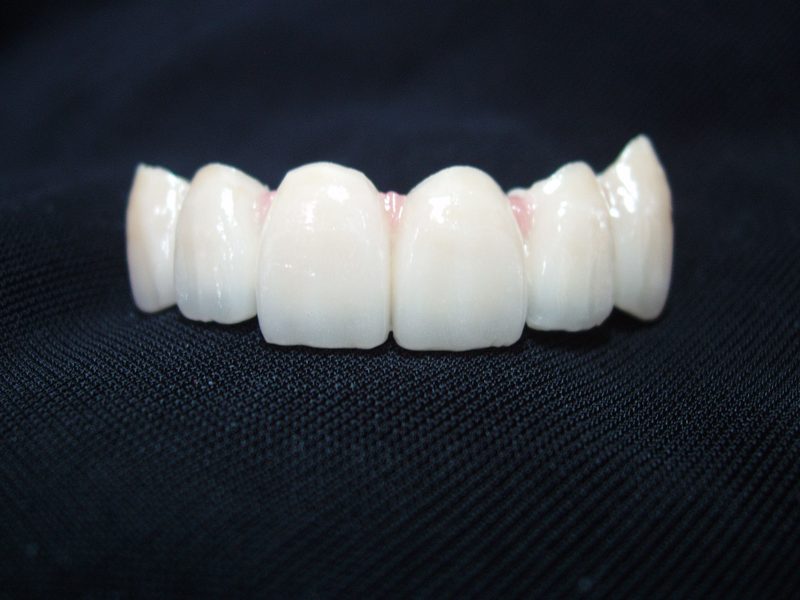 6-unit upper anterior smile-design restoration in layered porcelain, natural incisal translucency