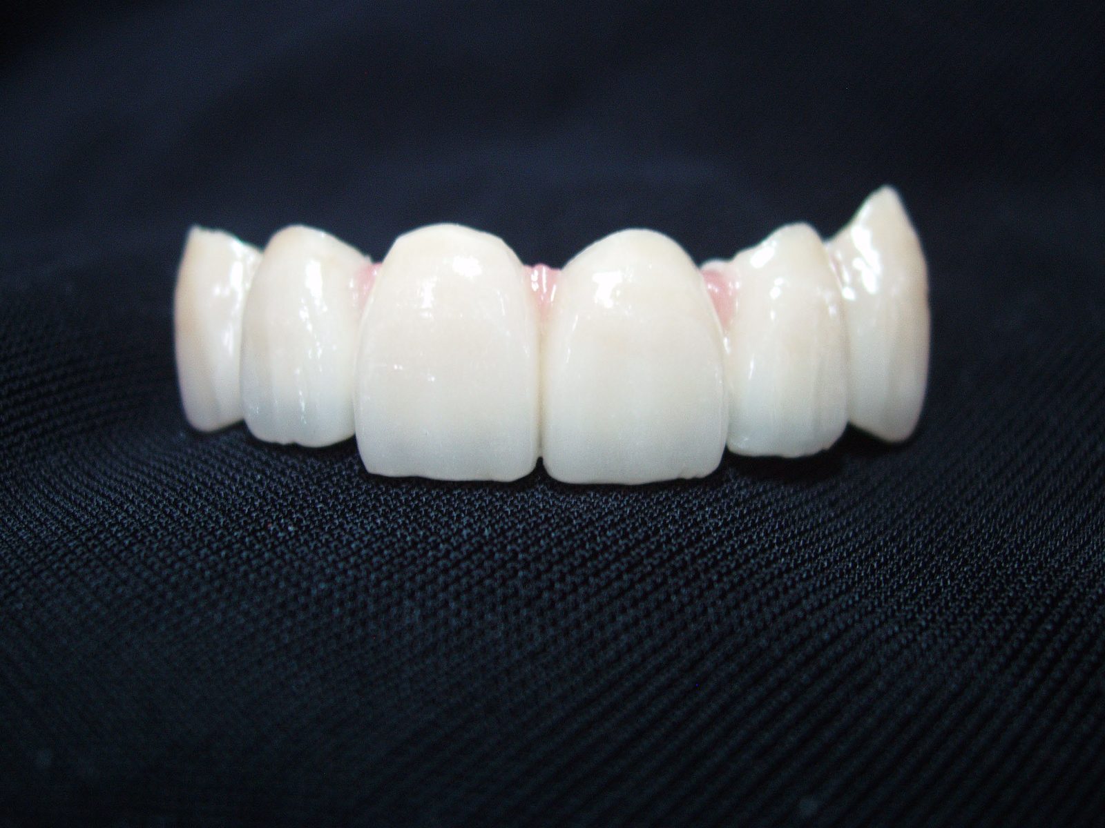 6-unit upper anterior smile-design restoration in layered porcelain