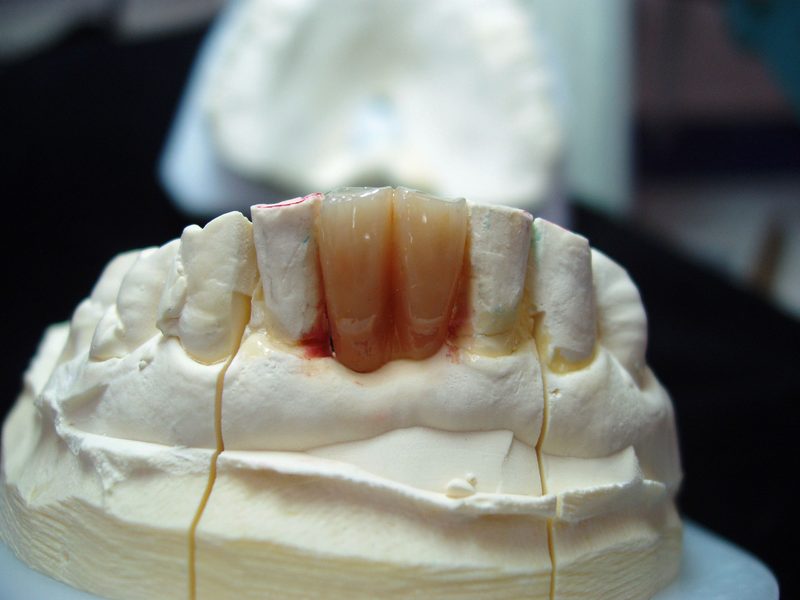 Hand-layered feldspathic porcelain veneer under fabrication on a refractory die, showing translucency and layering technique